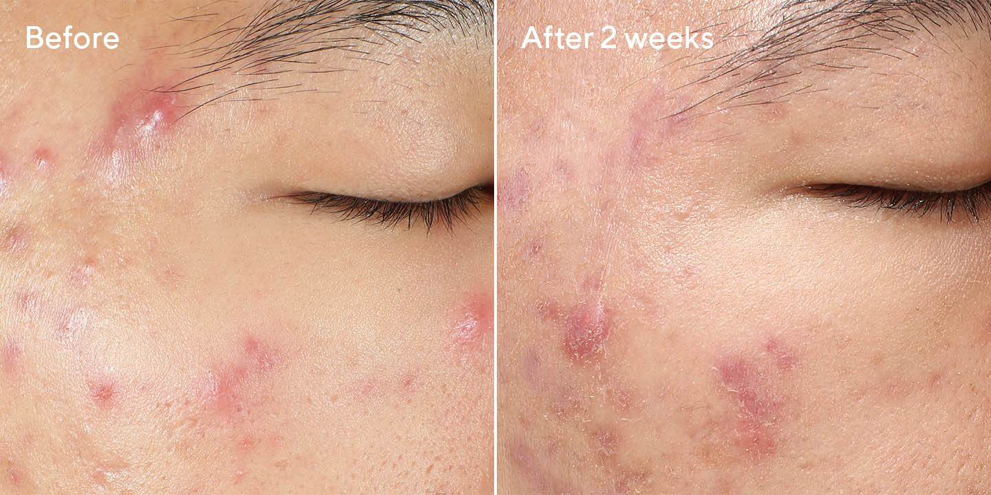 Murad Deep Relief Blemish Treatment 30ml