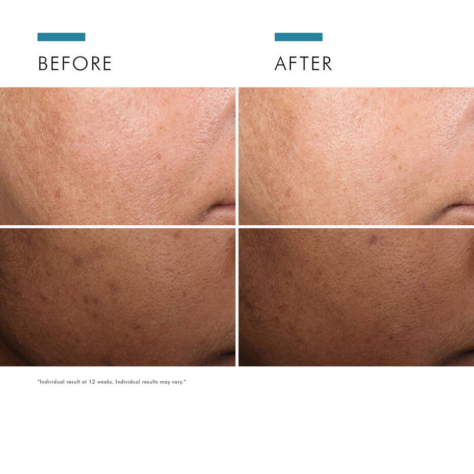 Discoloration Defense Serum