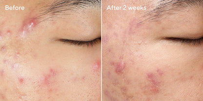 Murad Deep Relief Blemish Treatment 30ml