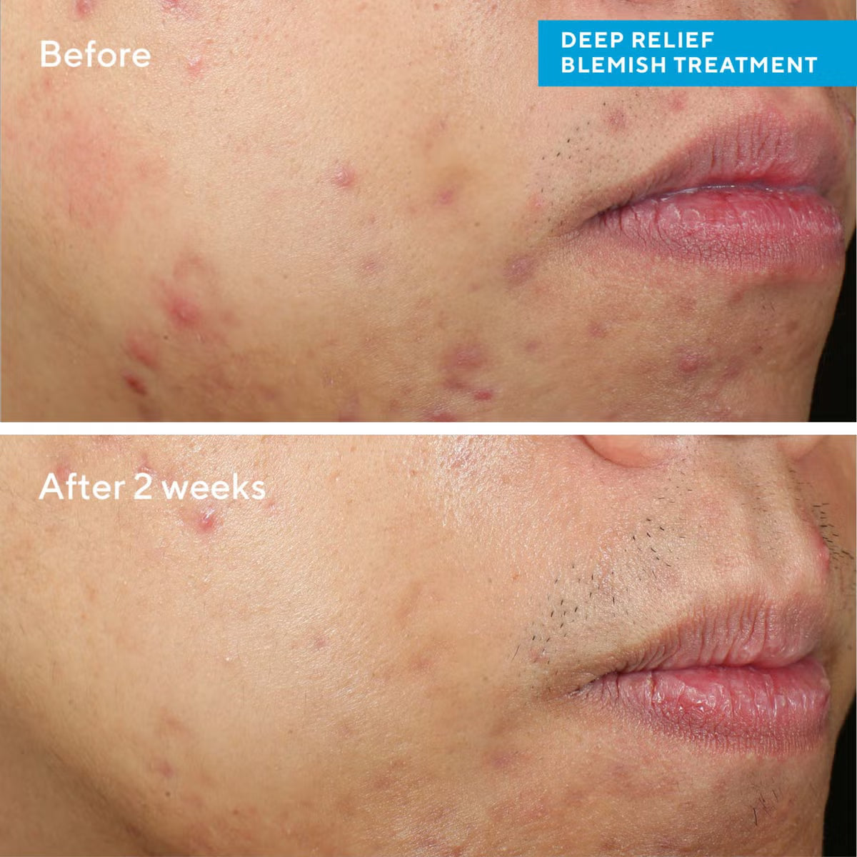 Murad Deep Relief Blemish Treatment 30ml