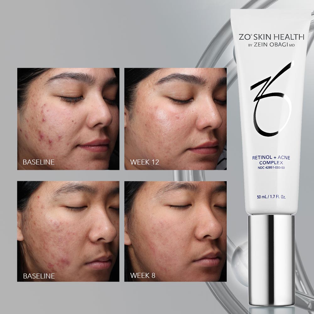 Retinol + Blemish Complex